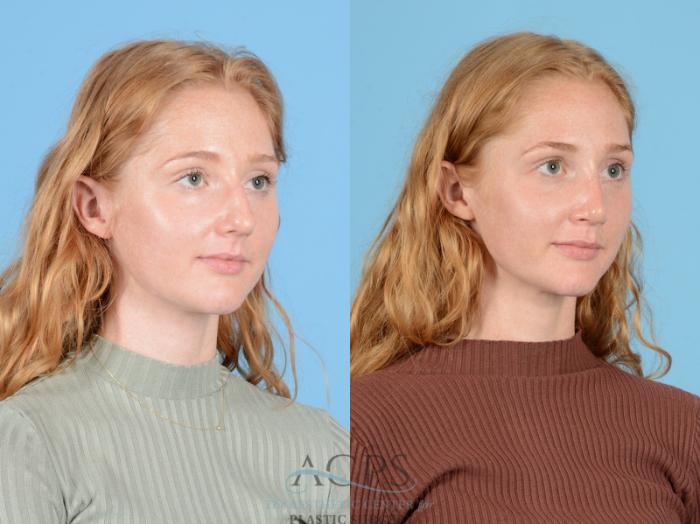Before & After Septoplasty with Rhinoplasty Case 1385 Oblique View: View in Houston, TX