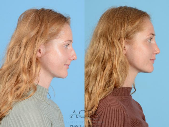 Before & After Septoplasty with Rhinoplasty Case 1385 Side View: View in Houston, TX