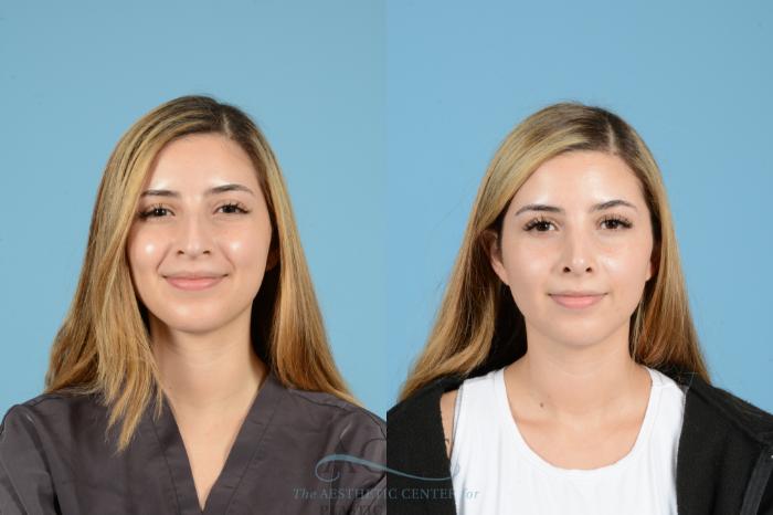 Before & After Septoplasty with Rhinoplasty Case 1518 Front View in Houston, TX