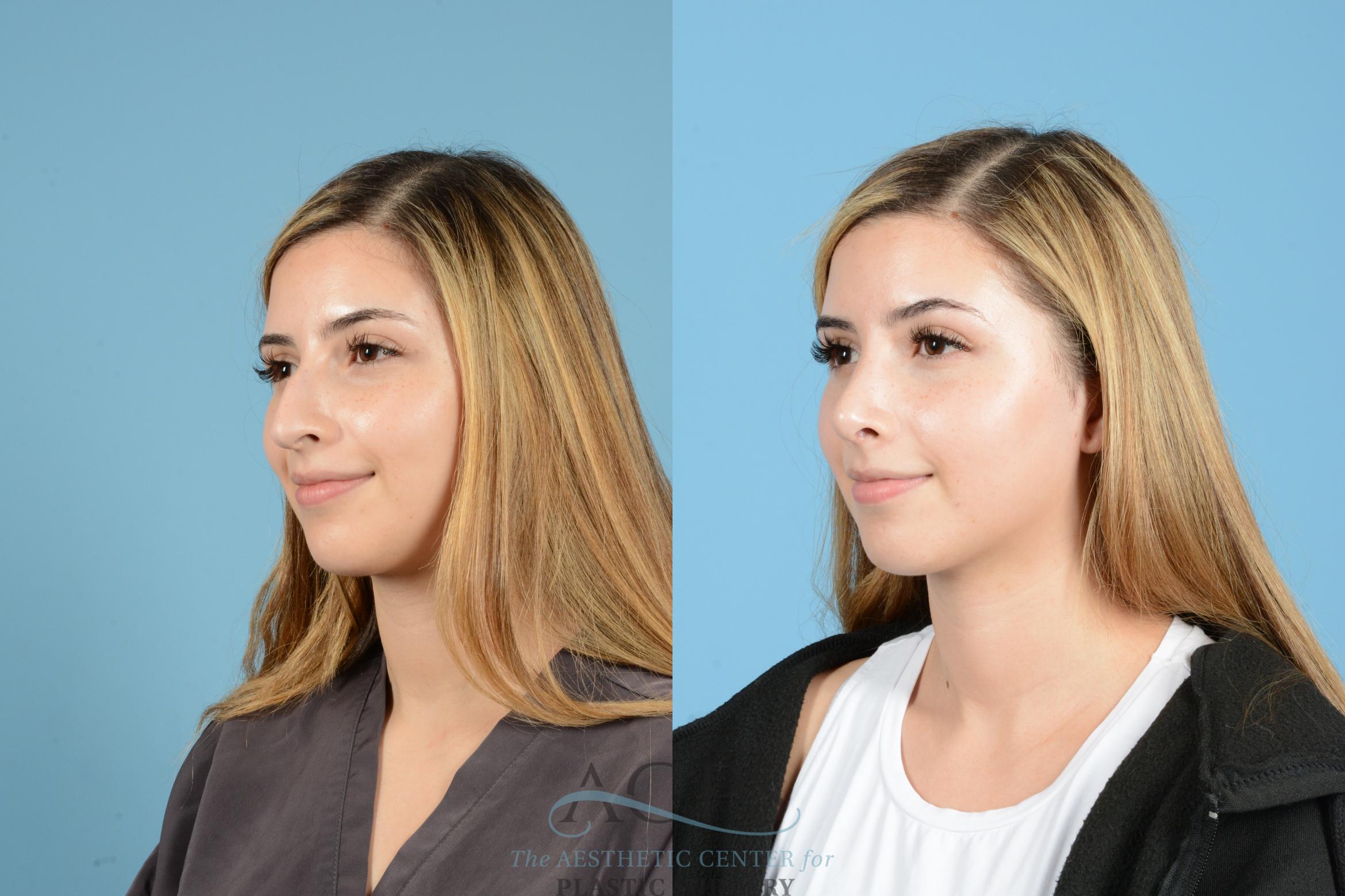 Before & After Septoplasty with Rhinoplasty Case 1518 Left Oblique View in Houston, TX