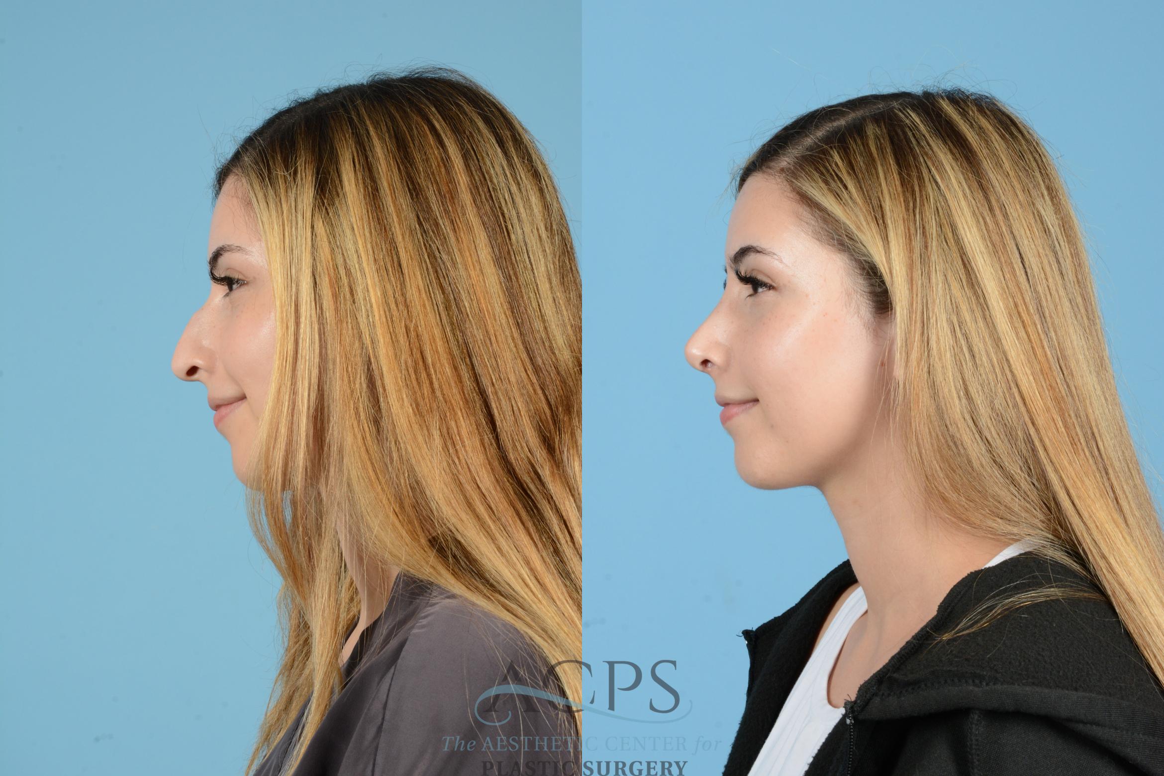 Before & After Septoplasty with Rhinoplasty Case 1518 Left Side View in Houston, TX