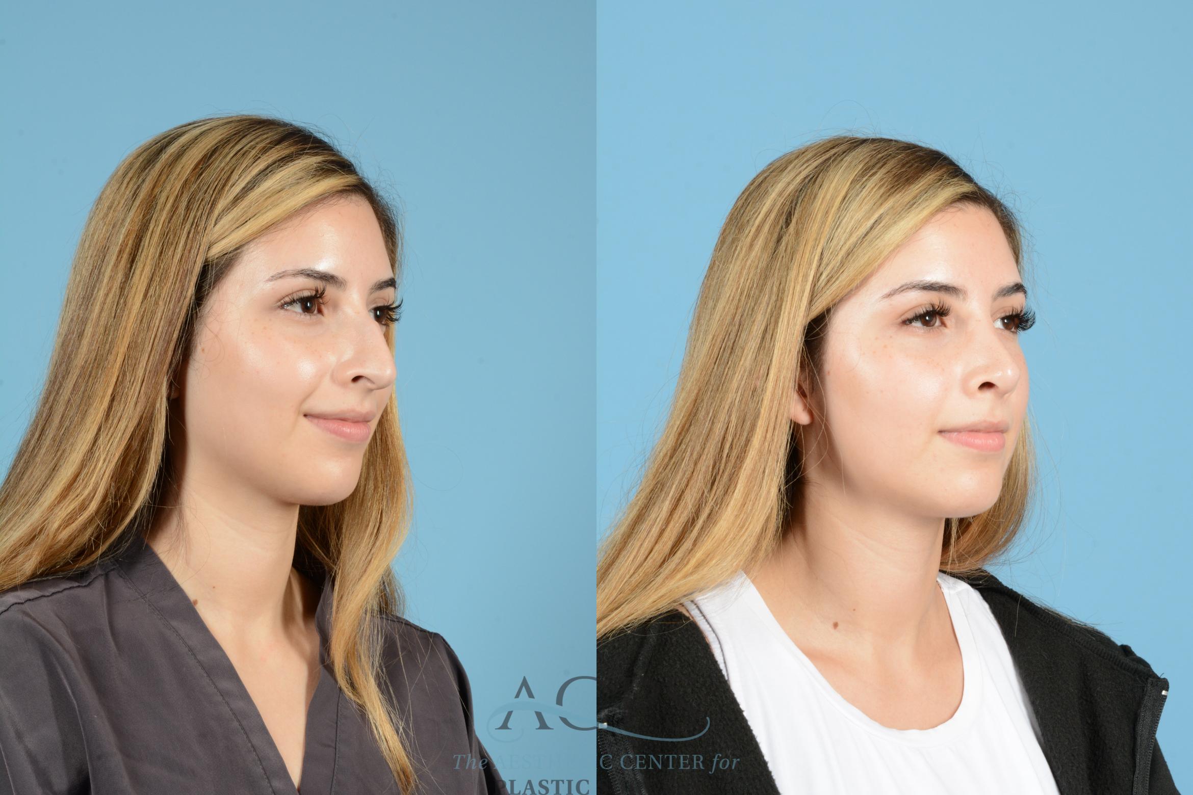 Before & After Septoplasty with Rhinoplasty Case 1518 Right Oblique View in Houston, TX