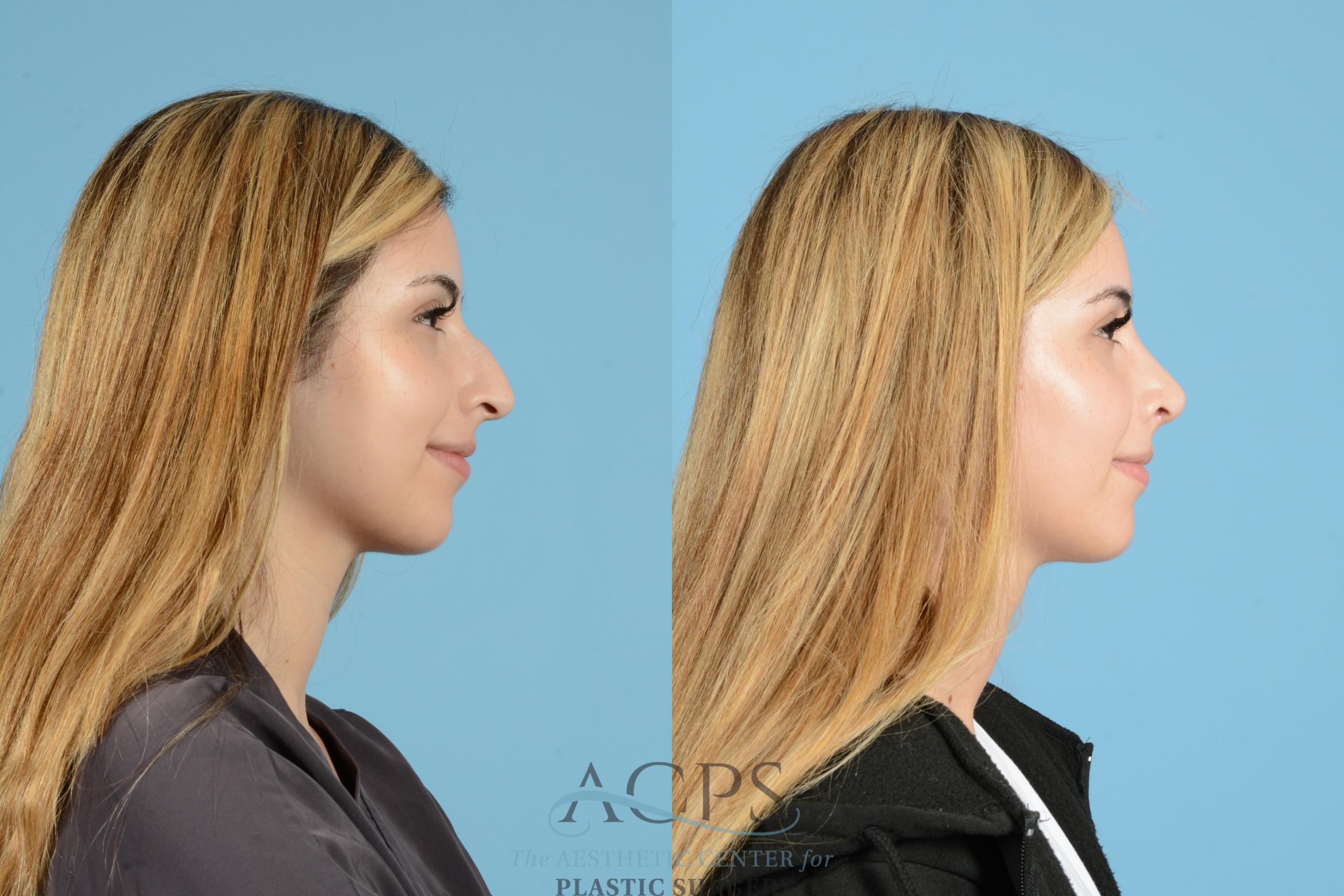 Before & After Septoplasty with Rhinoplasty Case 1518 Right Side View in Houston, TX