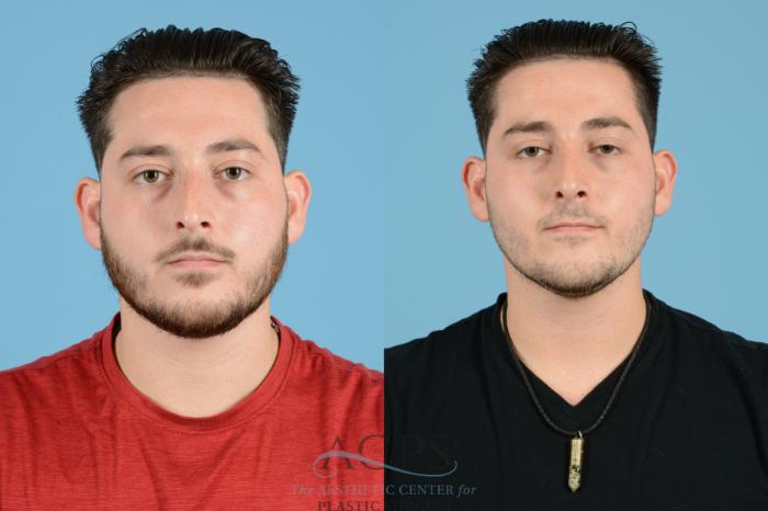 Before & After Septoplasty with Rhinoplasty Case 1536 Front View in Houston, TX