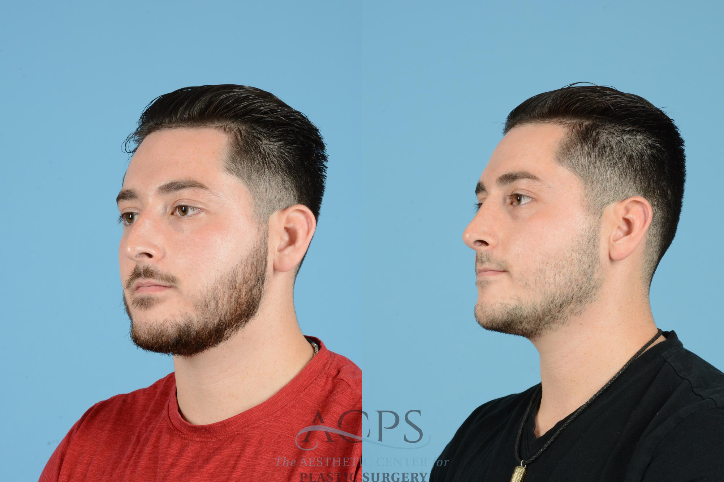 Before & After Septoplasty with Rhinoplasty Case 1536 Left Oblique View in Houston, TX