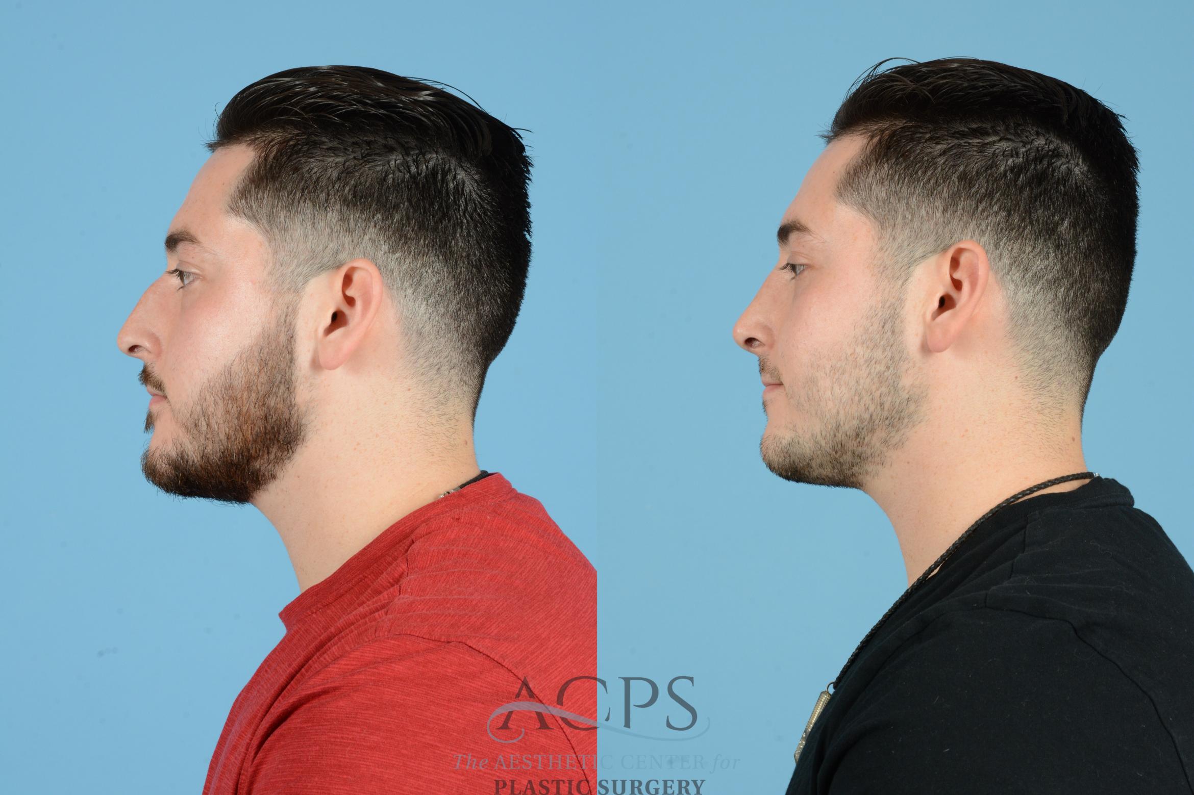 Before & After Septoplasty with Rhinoplasty Case 1536 Left Side View in Houston, TX