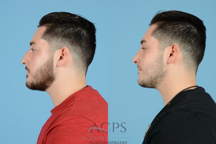 Before & After Septoplasty with Rhinoplasty Case 1536 Left Side View in Houston, TX