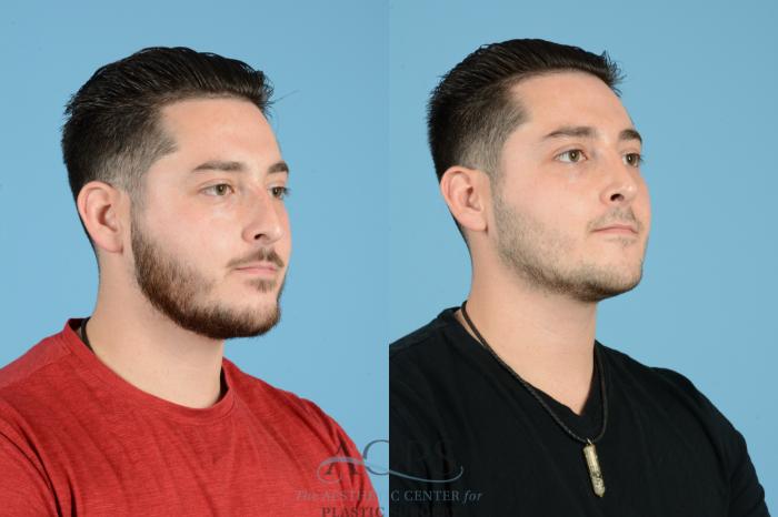 Before & After Septoplasty with Rhinoplasty Case 1536 Right Oblique View in Houston, TX