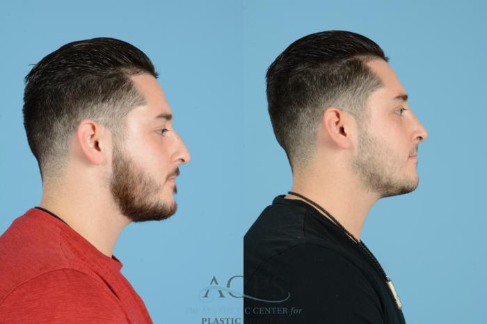 Before & After Septoplasty with Rhinoplasty Case 1536 Right Side View in Houston, TX