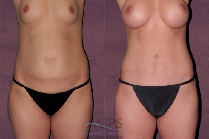 Before & After True Form Tummy Tuck Case 561 Front View: View in Houston, TX