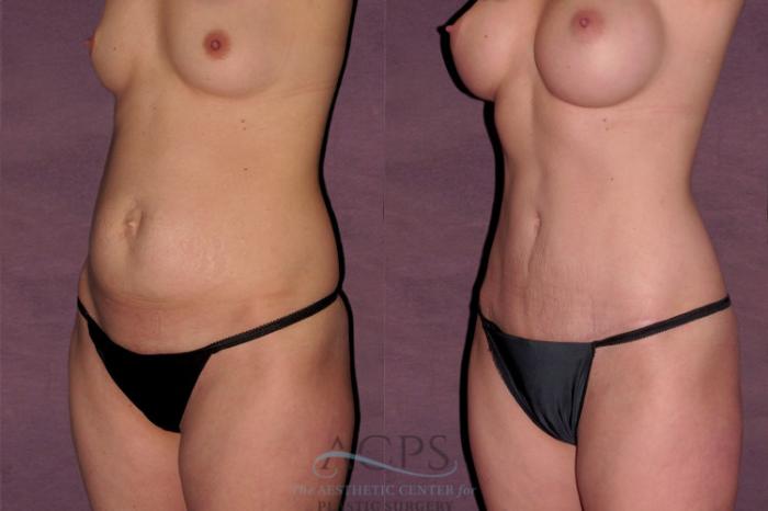 Before & After True Form Tummy Tuck Case 561 Oblique Left View: View in Houston, TX