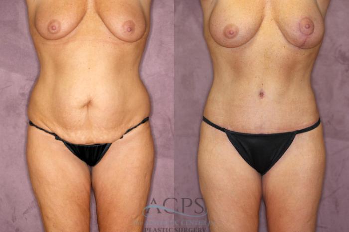 Before & After True Form Tummy Tuck Case 606 Front View: View in Houston, TX