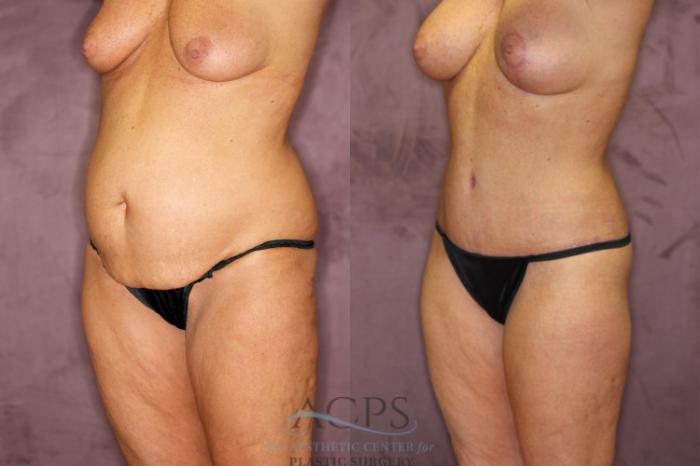 Before & After True Form Tummy Tuck Case 606 Oblique Left View: View in Houston, TX