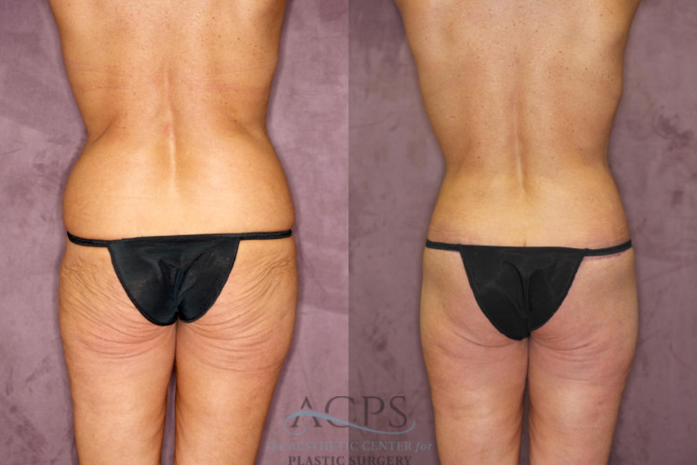 Before & After True Form Tummy Tuck Case 606 Rear View: View in Houston, TX
