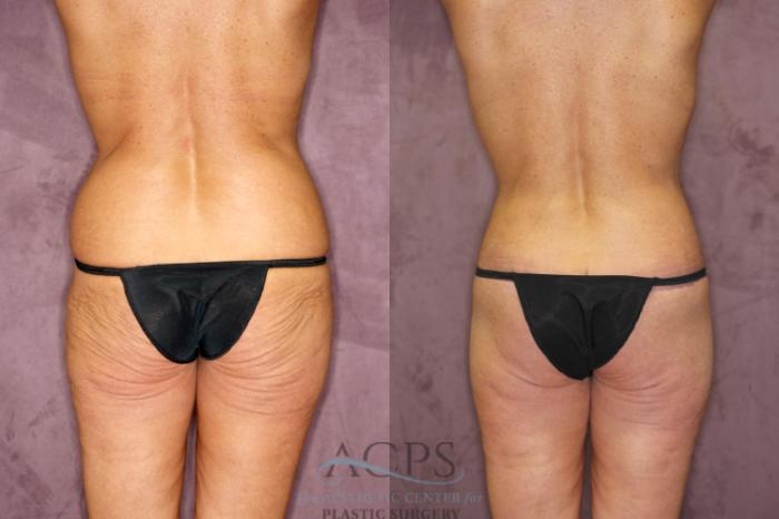 Before & After True Form Tummy Tuck Case 606 Rear View: View in Houston, TX