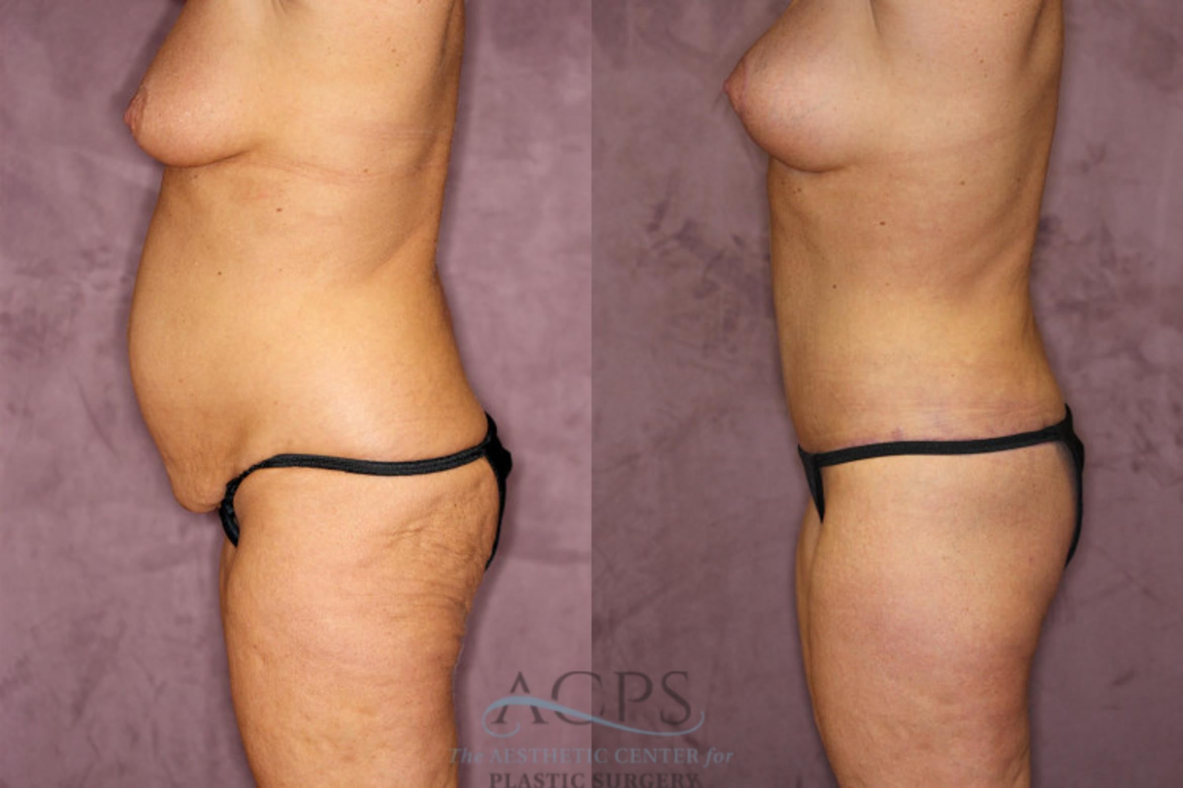 Before & After True Form Tummy Tuck Case 606 Side Left View: View in Houston, TX
