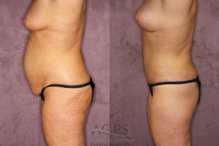 Before & After True Form Tummy Tuck Case 606 Side Left View: View in Houston, TX