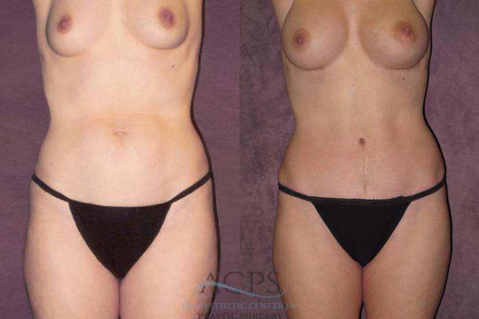 Before & After True Form Tummy Tuck Case 680 Front View: View in Houston, TX