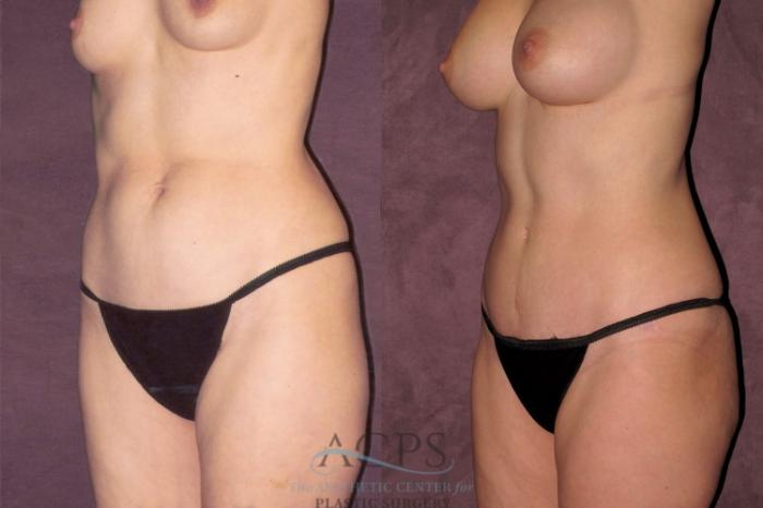 Before & After True Form Tummy Tuck Case 680 Oblique Left View: View in Houston, TX