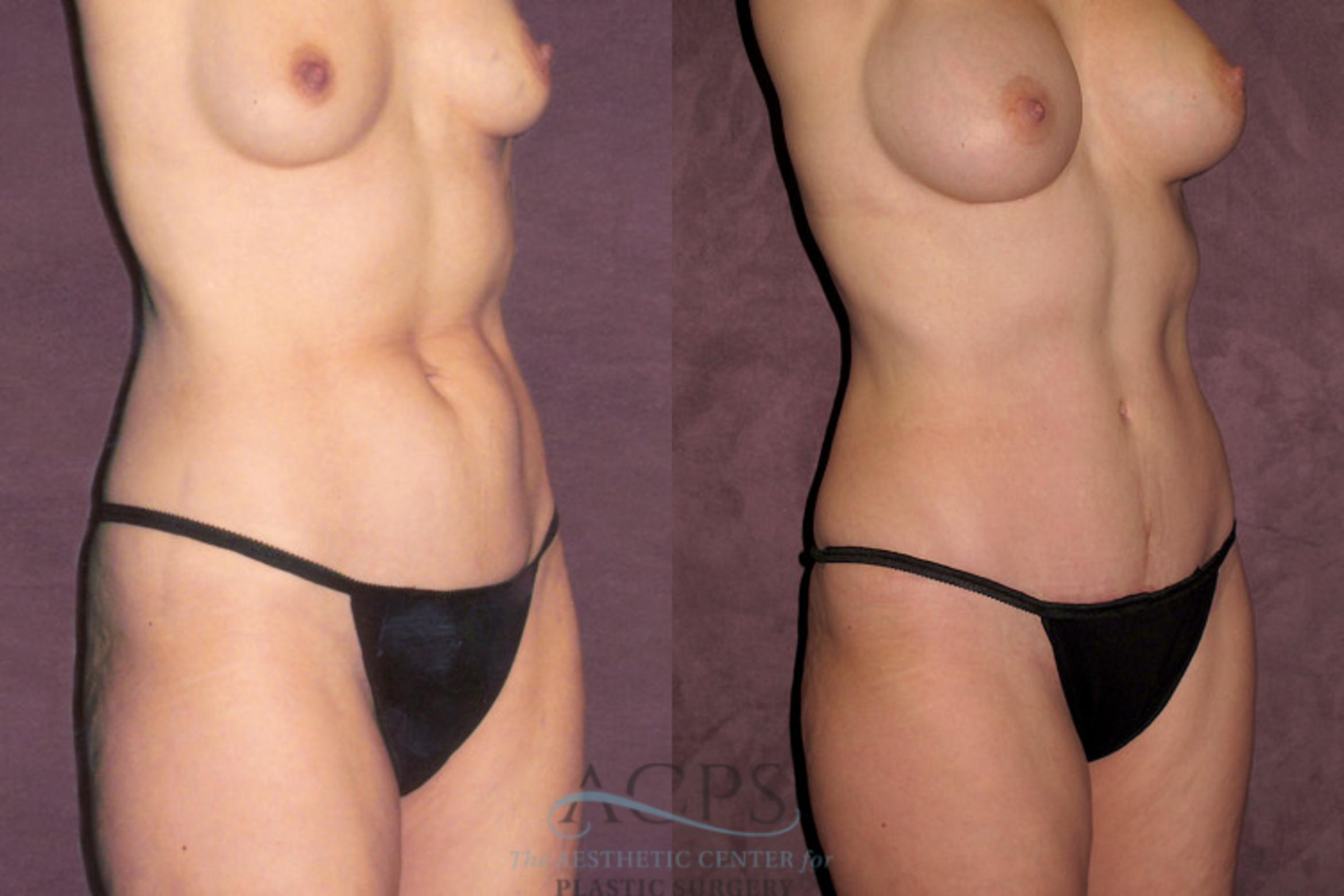Before & After True Form Tummy Tuck Case 680 Oblique Right View: View in Houston, TX