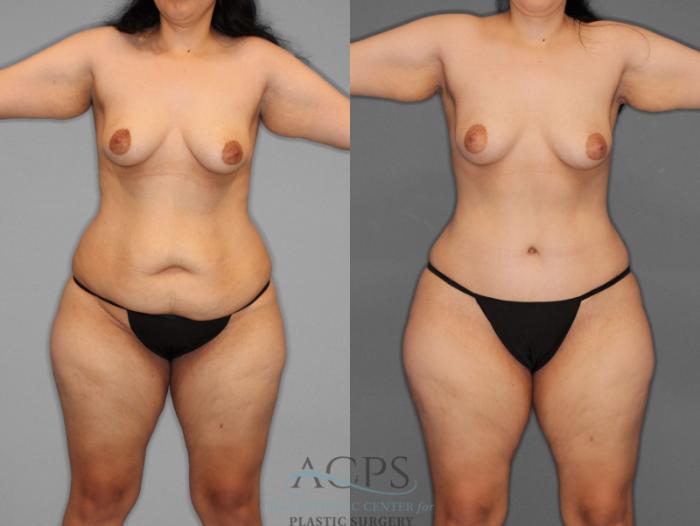 Before & After Tummy Tuck Case 1 Front View: View in Houston, TX