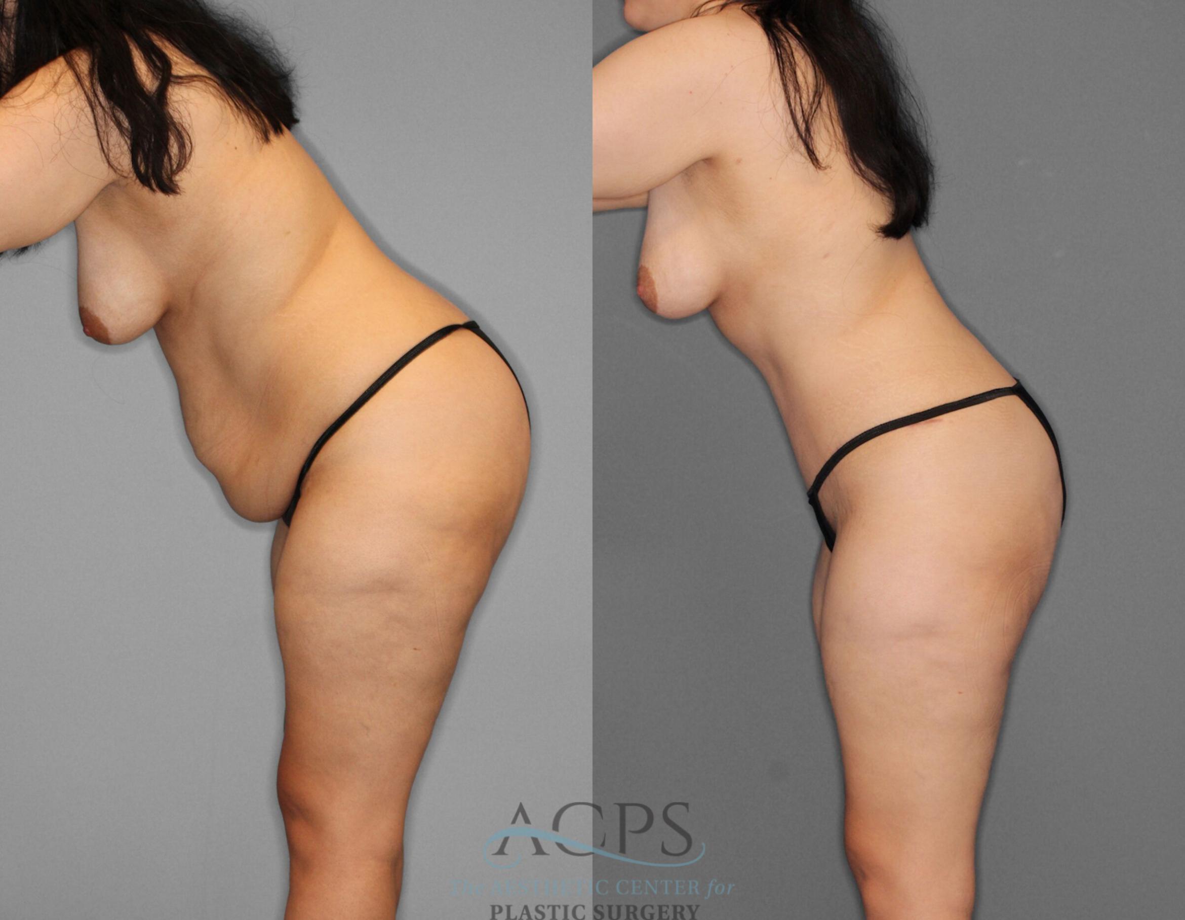 Before & After Tummy Tuck Case 1 Left Side Bend View: View in Houston, TX