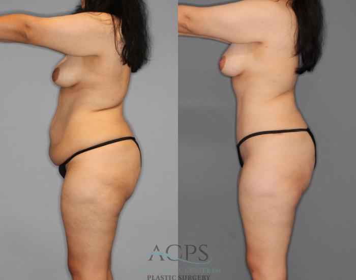 Before & After Tummy Tuck Case 1 Left Side View: View in Houston, TX