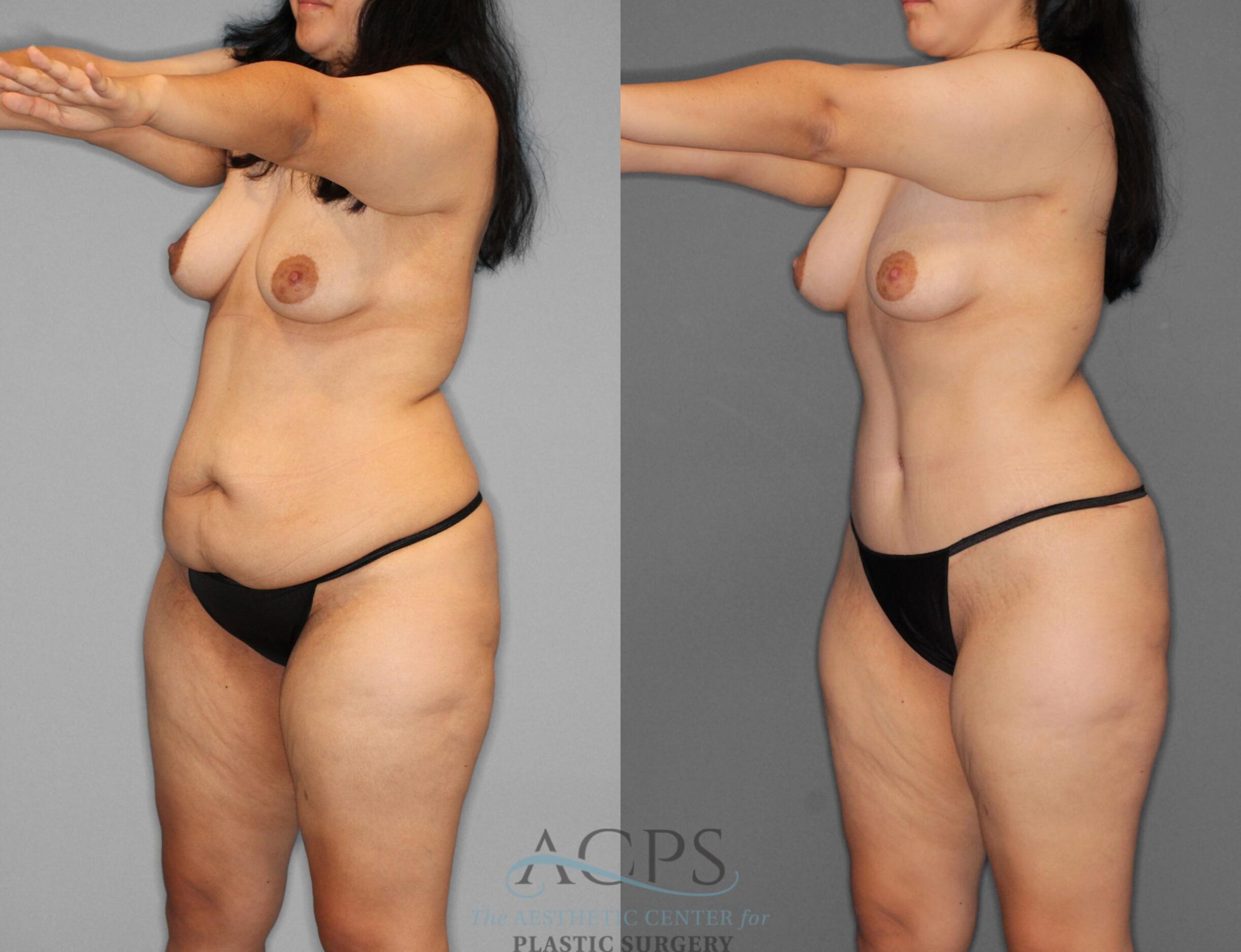 Before & After Tummy Tuck Case 1 Oblique View: View in Houston, TX