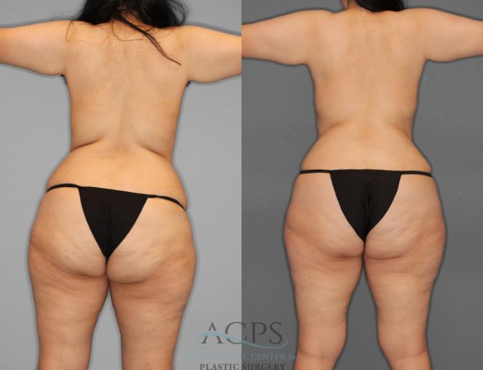 Before & After Tummy Tuck Case 1 Rear View: View in Houston, TX