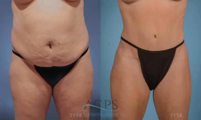 Before & After Tummy Tuck Case 10 Front View: View in Houston, TX