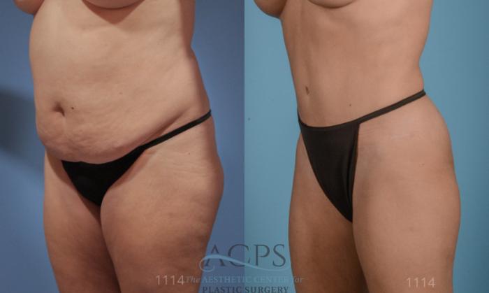 Before & After Tummy Tuck Case 10 Oblique View: View in Houston, TX