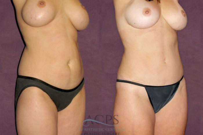 Before & After Tummy Tuck Case 100 Oblique Right View: View in Houston, TX