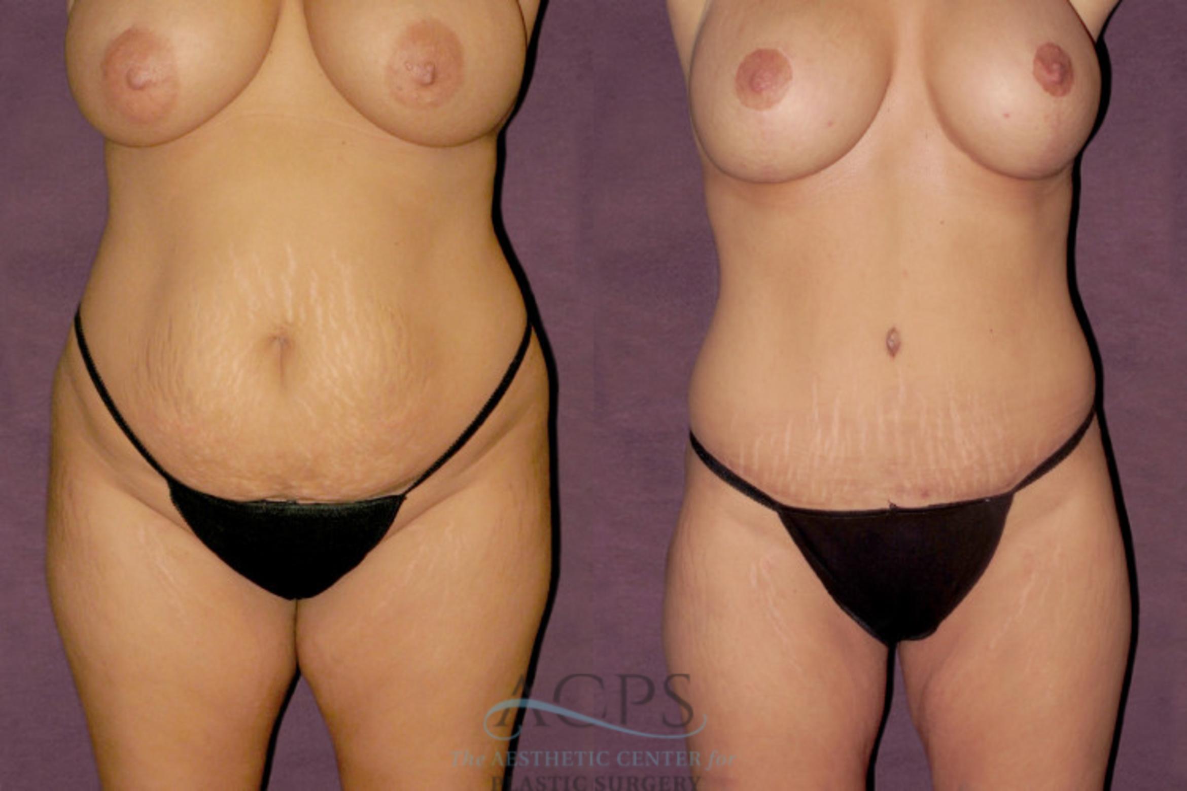 Before & After Tummy Tuck Case 101 Front View: View in Houston, TX