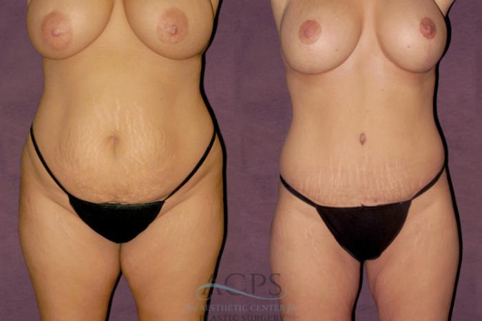 Before & After Tummy Tuck Case 101 Front View: View in Houston, TX