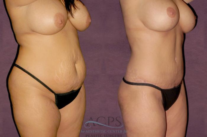 Before & After Tummy Tuck Case 101 Oblique Right View: View in Houston, TX