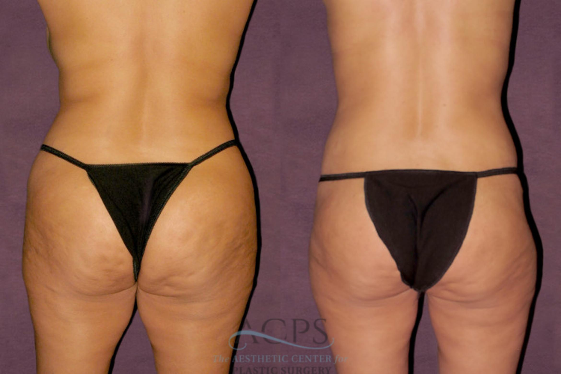 Before & After Tummy Tuck Case 101 Rear View: View in Houston, TX