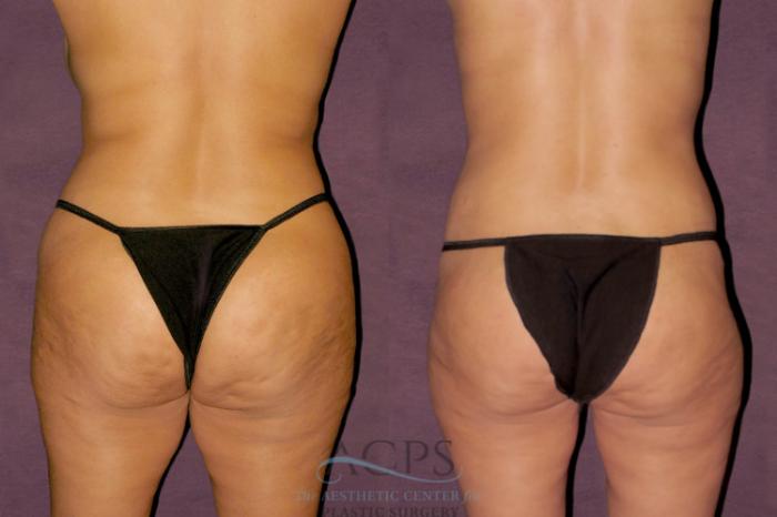 Before & After Tummy Tuck Case 101 Rear View: View in Houston, TX