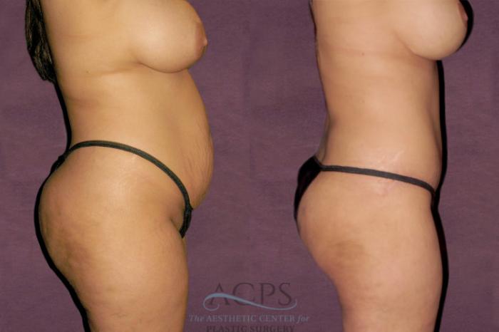 Before & After Tummy Tuck Case 101 Side Right View: View in Houston, TX