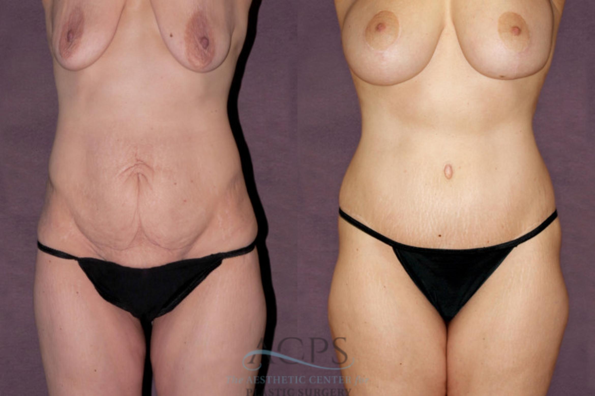 Before & After Tummy Tuck Case 102 Front View: View in Houston, TX