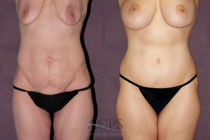 Before & After Tummy Tuck Case 102 Front View: View in Houston, TX
