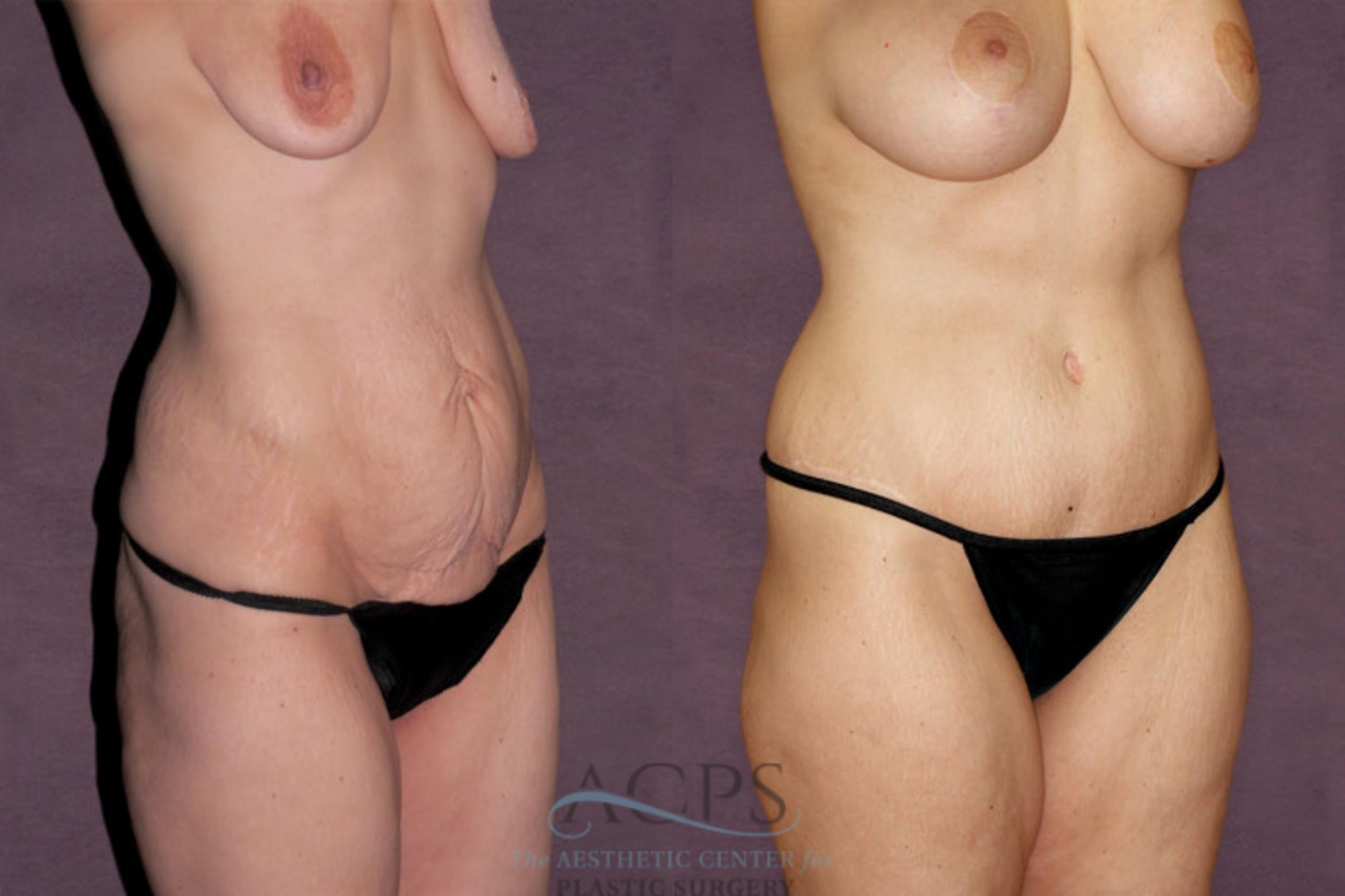 Before & After Tummy Tuck Case 102 Oblique Right View: View in Houston, TX
