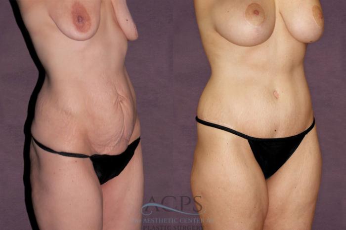 Before & After Tummy Tuck Case 102 Oblique Right View: View in Houston, TX