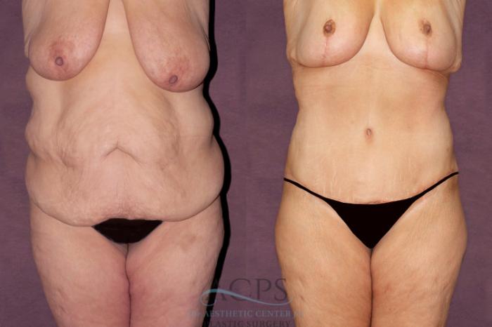 Before & After Tummy Tuck Case 103 Front View: View in Houston, TX