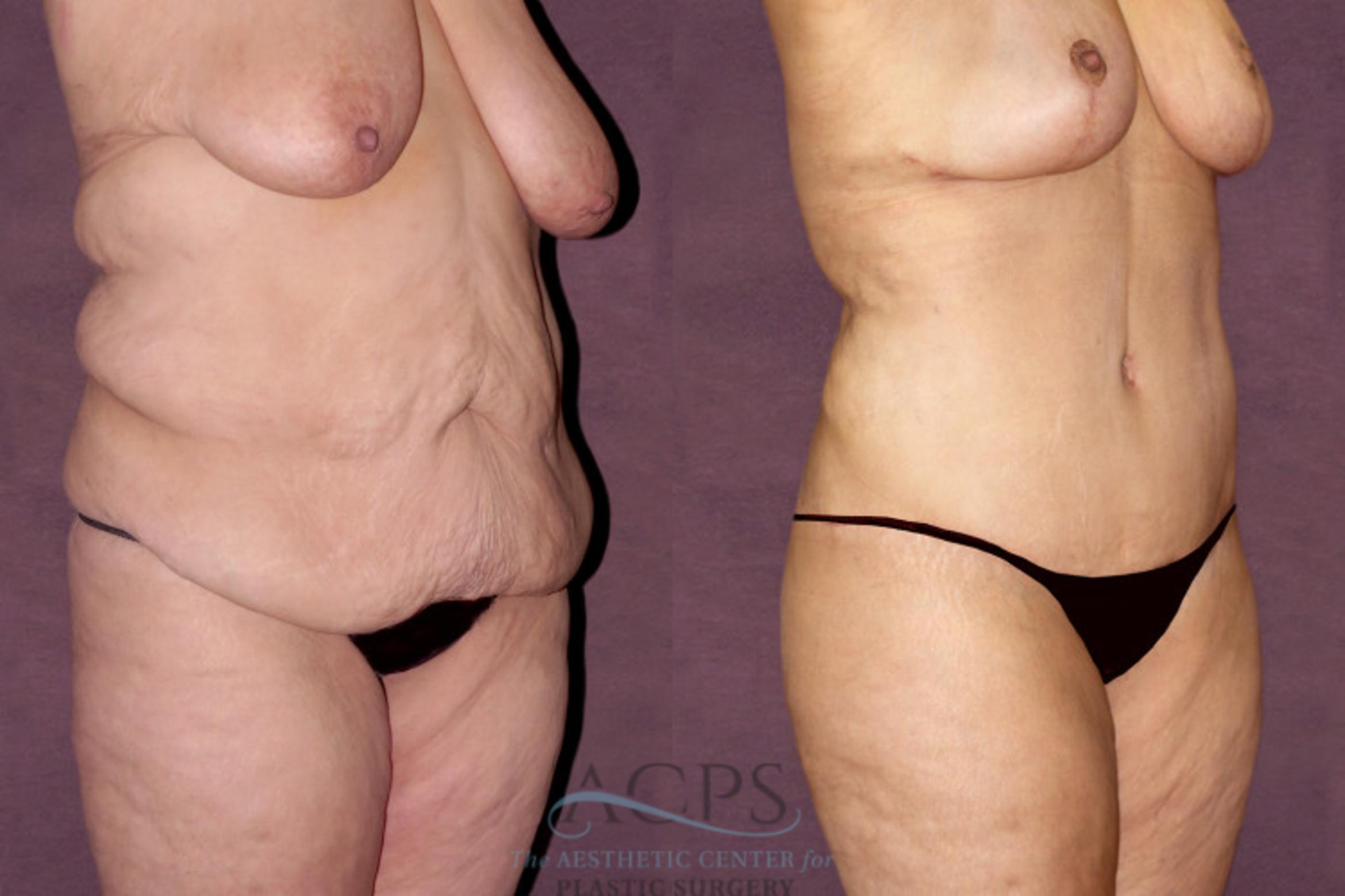 Before & After Tummy Tuck Case 103 Oblique Right View: View in Houston, TX