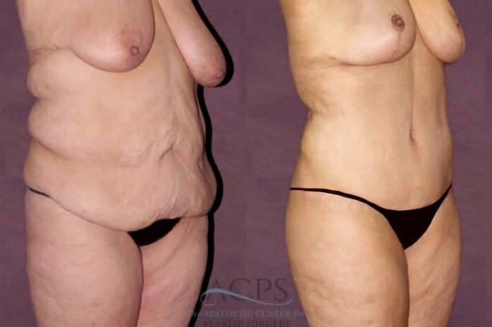 Before & After Tummy Tuck Case 103 Oblique Right View: View in Houston, TX