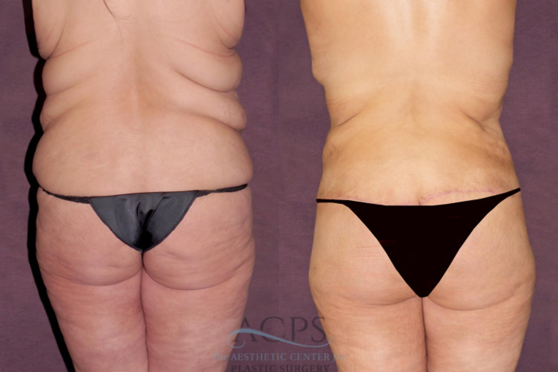 Before & After Tummy Tuck Case 103 Rear View: View in Houston, TX