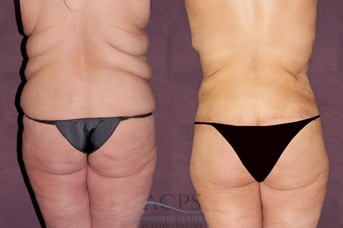 Before & After Tummy Tuck Case 103 Rear View: View in Houston, TX