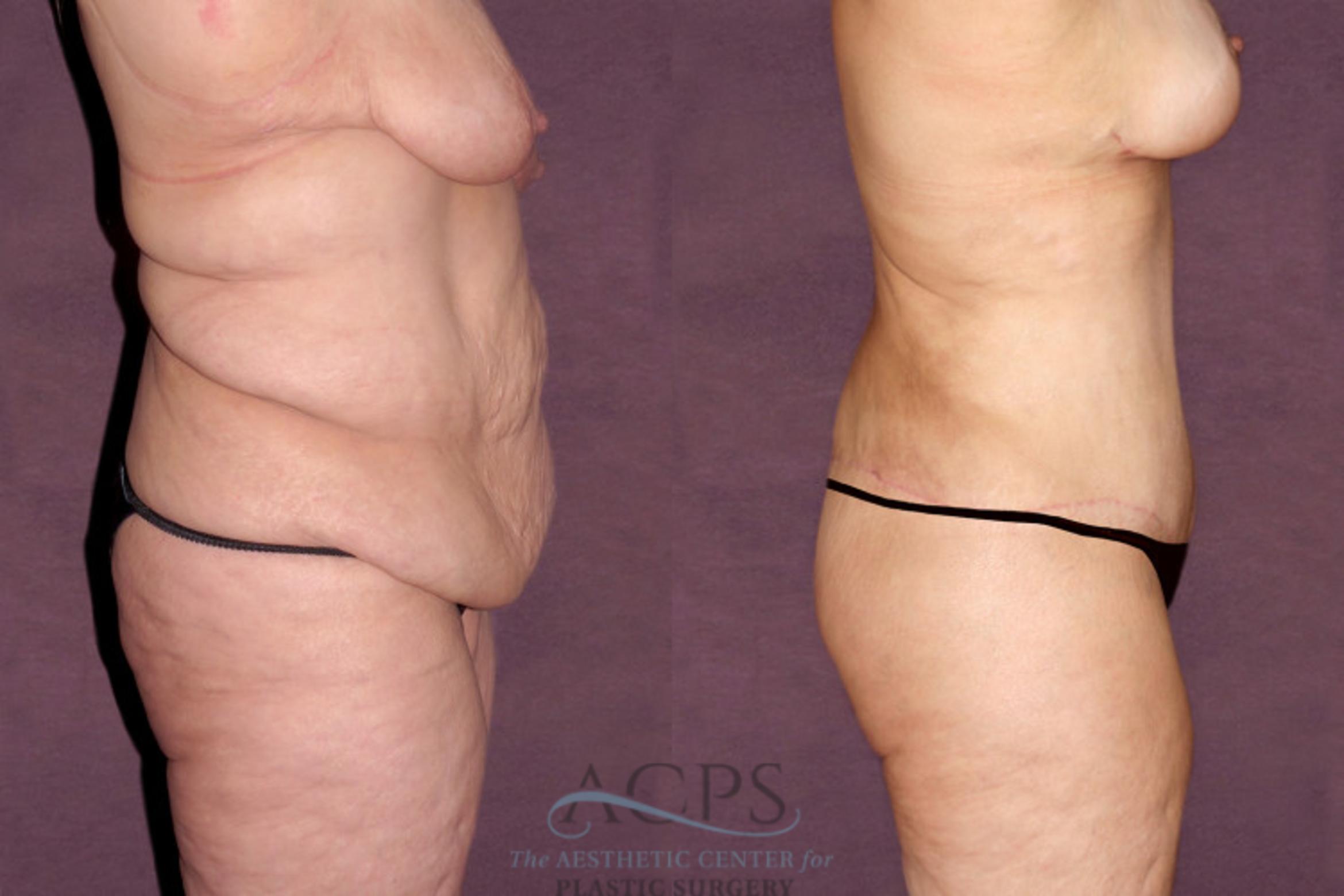 Before & After Tummy Tuck Case 103 Side Right View: View in Houston, TX