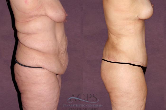 Before & After Tummy Tuck Case 103 Side Right View: View in Houston, TX