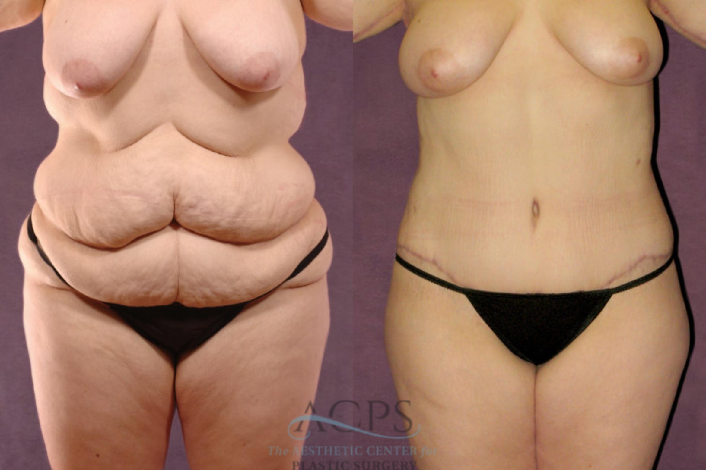 Before & After Body Lift Case 104 Front View: View in Houston, TX